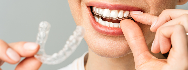 Woman inserting Invisalign onto their teeth and holding another Invisalign in other hand