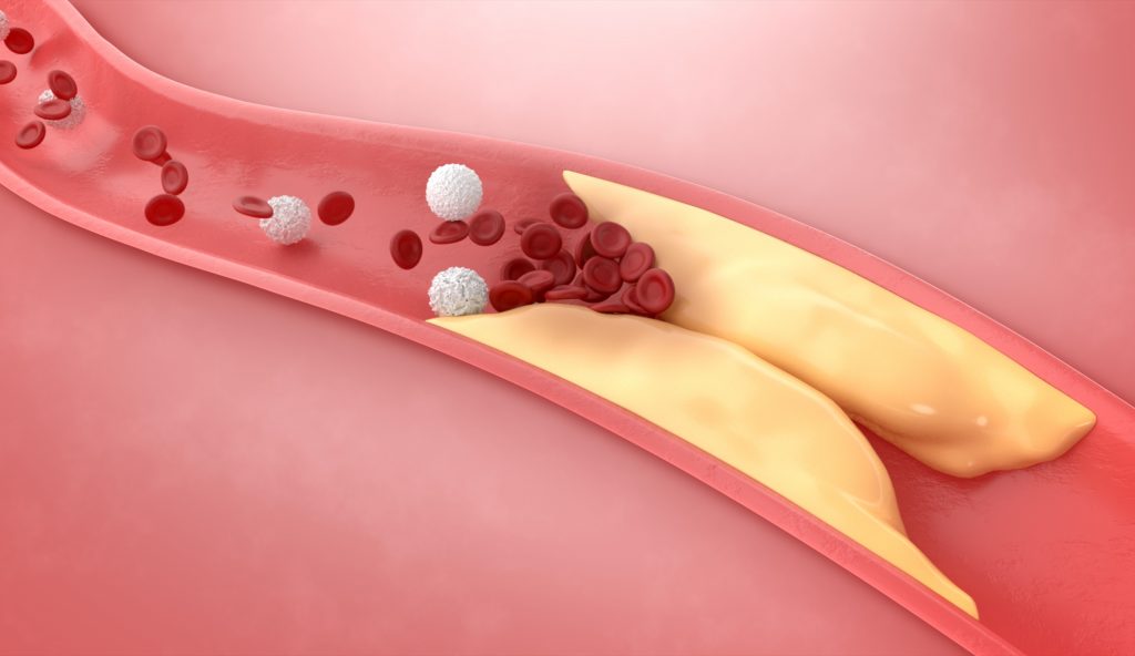 Arterial plaque buildup in blood vessels. A yellowish substance narrows the artery, increasing the risk of heart disease