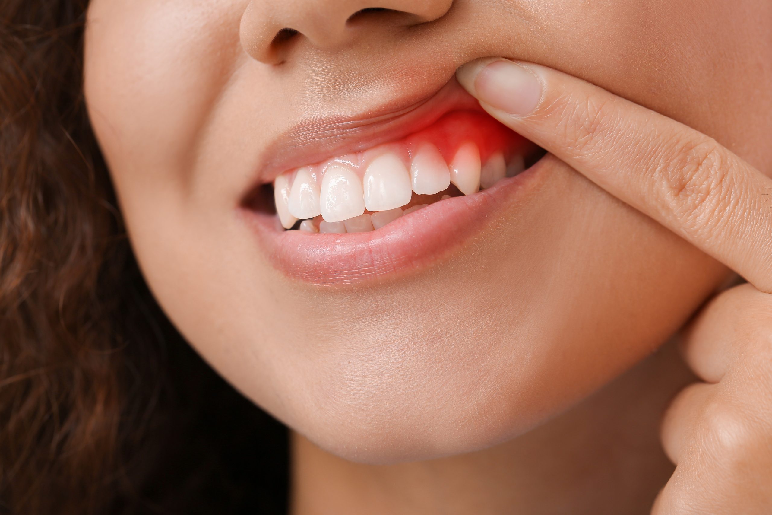 A woman holding up her lips, indicating gum disease