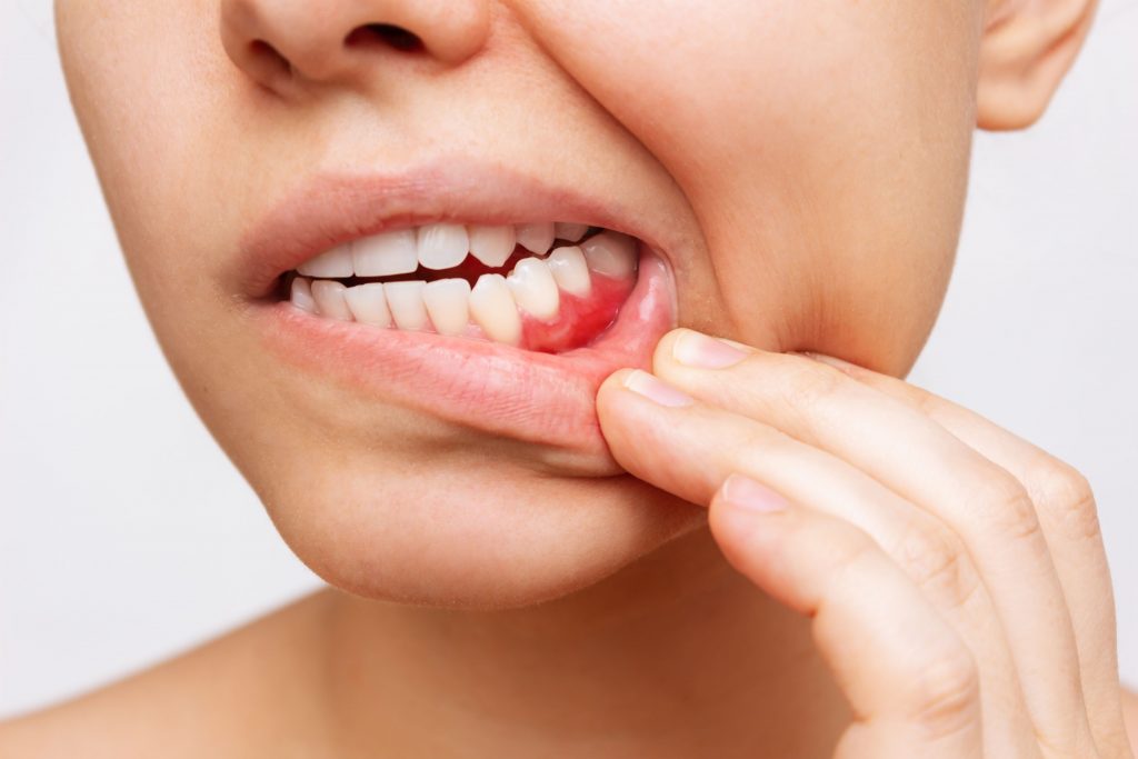 Close-up of gums in a smiling mouth.