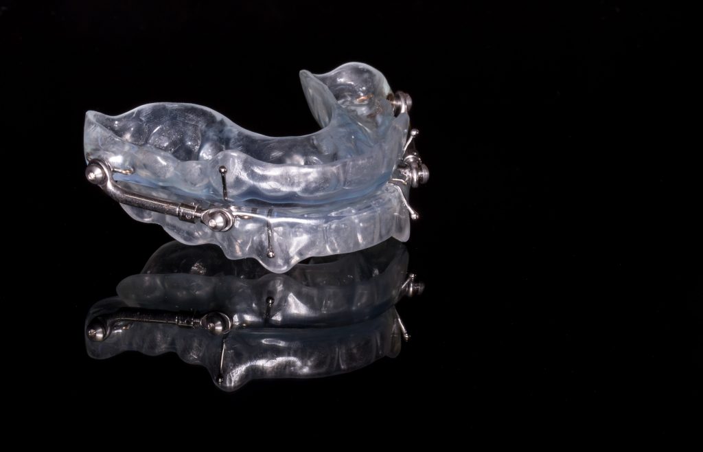 A detailed photo of an oral appliance therapy device being worn by a person for medical treatment.
