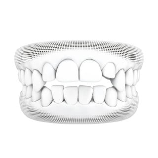 3D wireframe model of open bite teeth