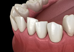 Digital illustration of misaligned teeth with crowding on lower jaw