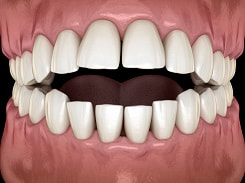 Digital illustration of teeth with open bite