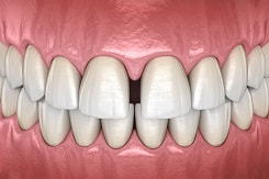 Digital illustration of teeth with gap in the front