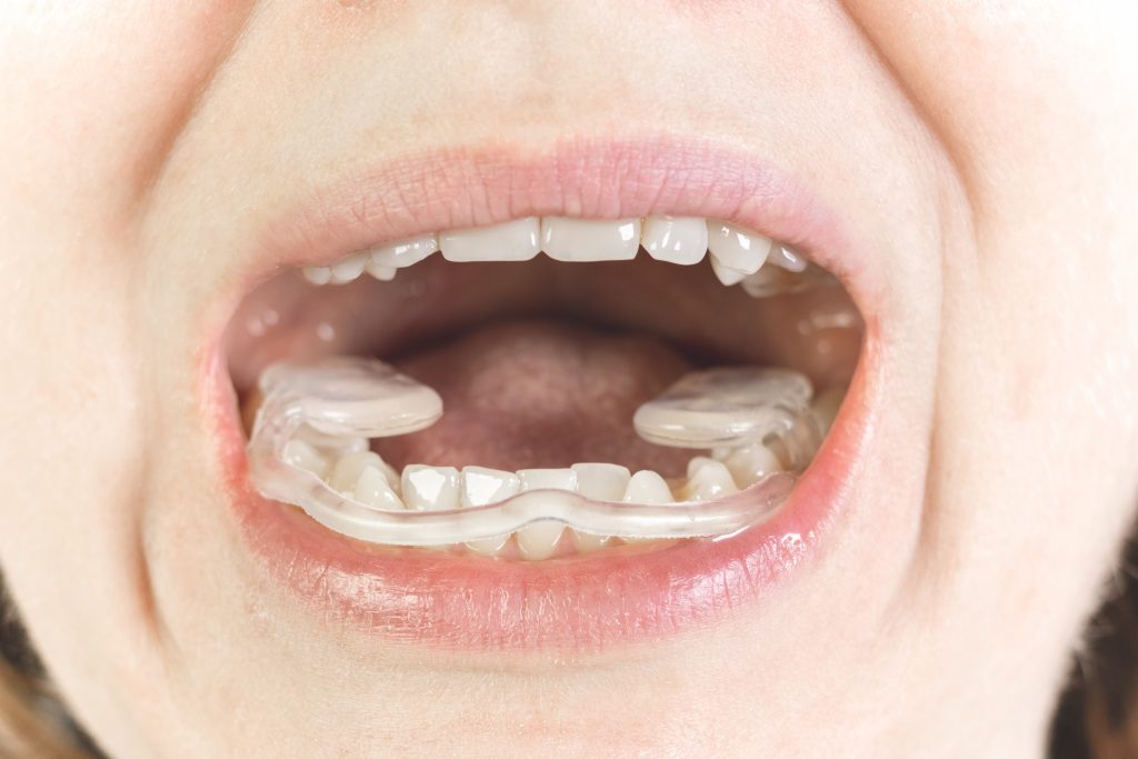 a woman wearing an invisalign