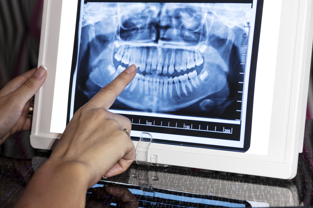 dental panoramic xray